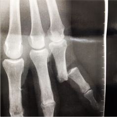 The first X-ray before it was corrected